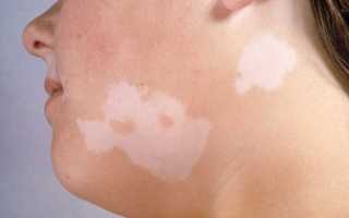 Чем лечить солнечный лишай