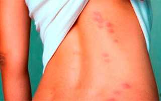 Причины красных пятен на теле