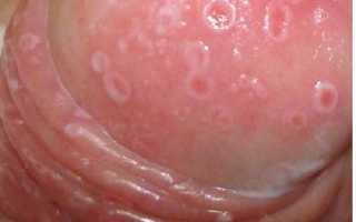 Лечение язвочек на головке члена у мужчин