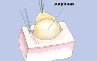 Белые прыщики на мошонке у мужчин