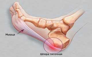 Причины возникновения шпор на пятке