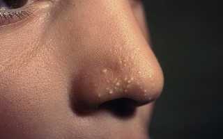 Милиумы на коже лица