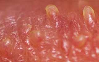 Перламутровые папулы на члене