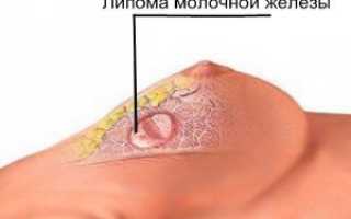 Первые признаки фибролипомы мягких тканей