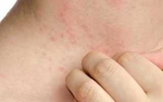 Симптомы и методы лечения кандидоза кожи