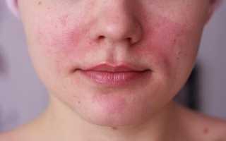 Причины возникновения красных пятен на лице