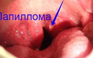 Что такое папилломатоз гортани и чем его лечить