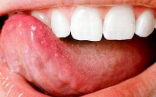 Под языком появились отростки