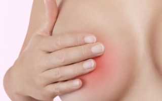 Отчего может чесаться молочные железы у женщин