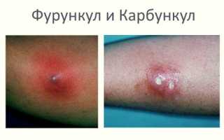 Что такое карбункул и чем его вылечить