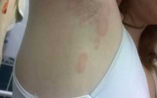 Как правильно лечить грибок подмышек