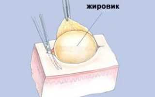 Как можно избавиться от жировика на голове