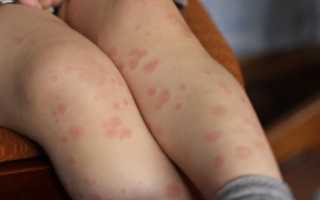 Красные шелушащиеся пятна на теле у ребенка