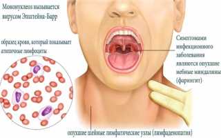 Вирус Эпштейна Барра у взрослых и детей – что это такое?