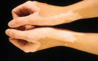 Причины появления белых пятен на коже