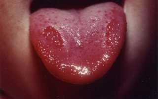 Как бороться с типуном на языке