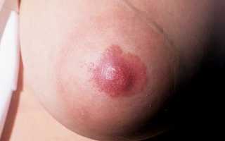 Как выявить и бороться с опухолью молочной железы Педжета