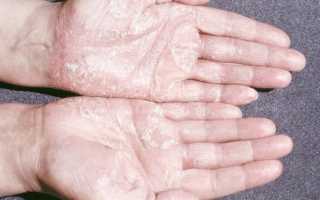 Признаки кератодермии на ладонях рук и подошве ног