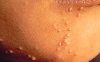 Лечение контагиозного моллюска на коже