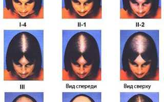 Причины андрогенетической алопеции у женщин