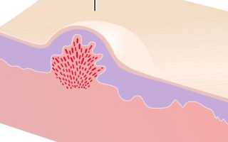 Лечение и причины папул на коже