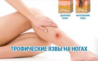 Причины и лечение трофических язв на ногах