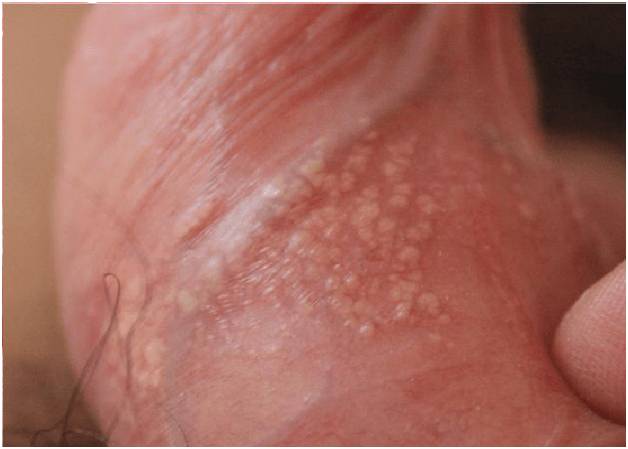 сыпь на головке мужского органа сыпь на головке мужского органа