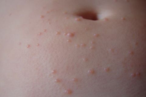 Чесотка - симптомы, фото и первые признаки