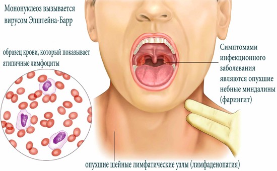 Вирус Эпштейна Барра у взрослых и детей - что это такое?