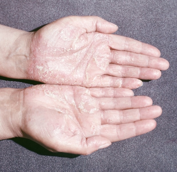 Признаки кератодермии на ладонях рук и подошве ног