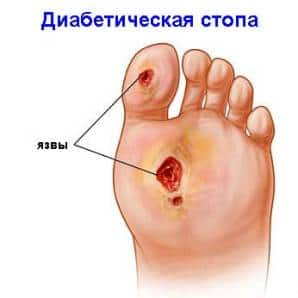 Первые признаки и лечение гангрены при диабете