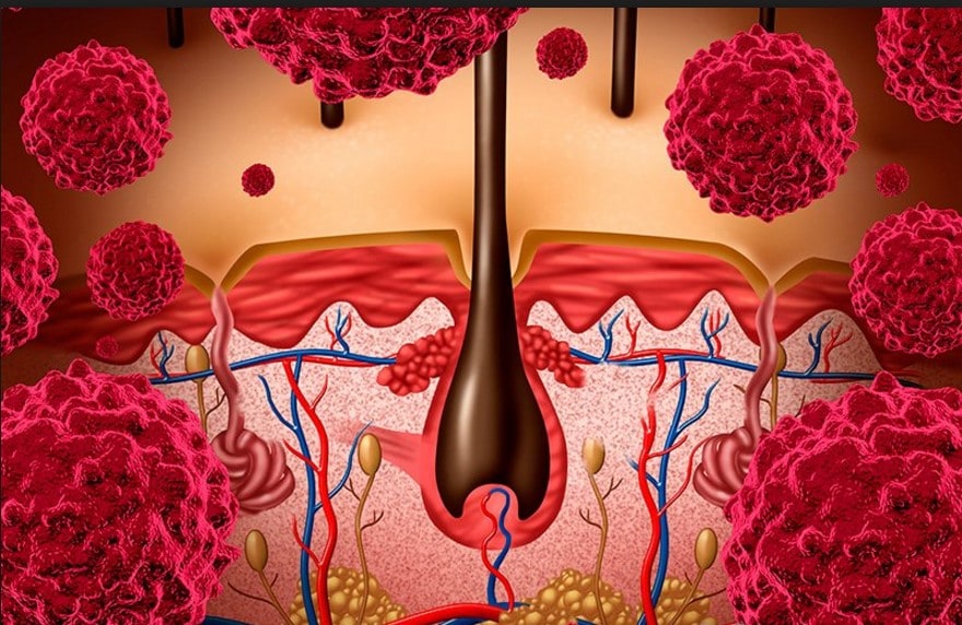 синдром лайелла синдром лайелла