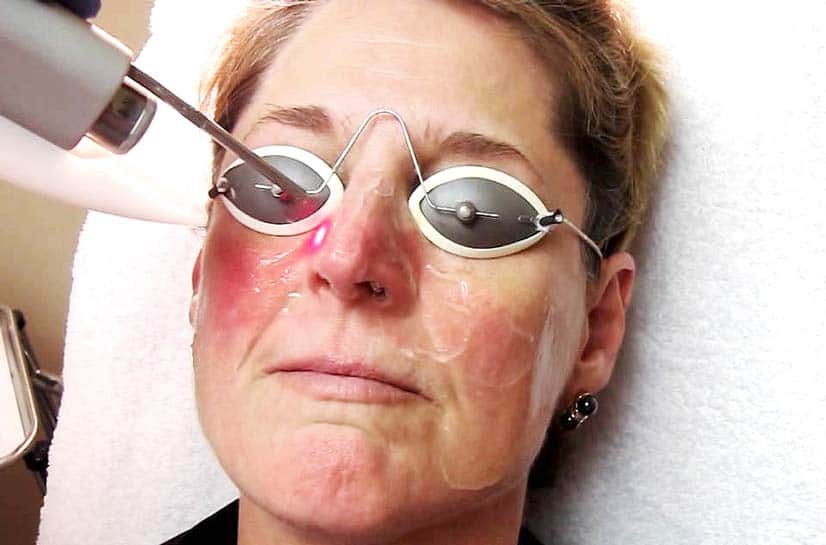 Причины и лечение красных щек у взрослых