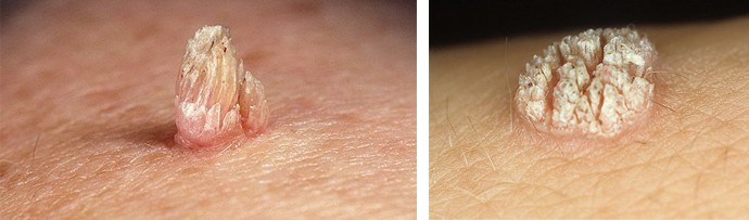 наросты на коже наросты на коже