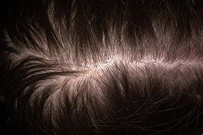 Причины андрогенетической алопеции у женщин