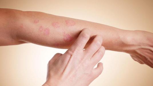 Синдром Лайелла у детей и взрослых