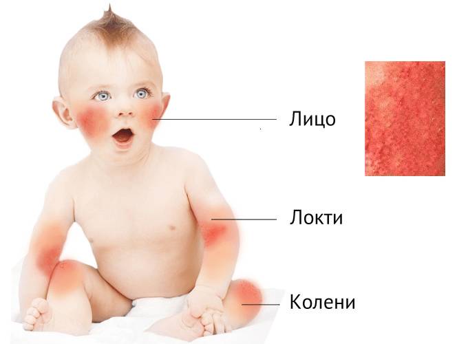 симптомы при атопическом дерматите у грудничка