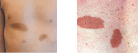 Причины появления белых пятен на коже