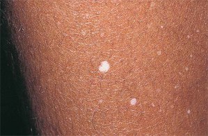 на коже появились белые пятна на коже появились белые пятна