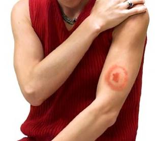 клещевой боррелиоз клещевой боррелиоз