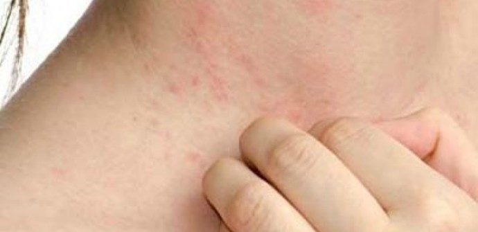 Симптомы и методы лечения кандидоза кожи