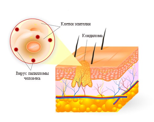 признаки вируса кандиломы