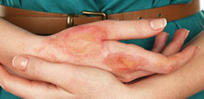 Причины и лечение эксфолиативного дерматита Риттера
