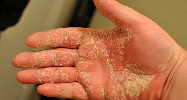 Как применять Солидол от кожных заболеваний