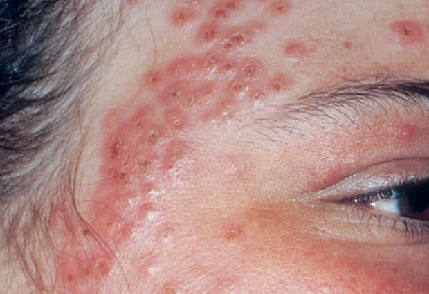 Как выглядит на фото экзема на лице Как выглядит на фото экзема на лице