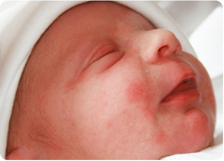 токсическая эритема новорожденных токсическая эритема новорожденных