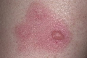 многоформная экссудативная эритема многоформная экссудативная эритема