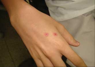 Лечение многоформной экссудативной эритемы