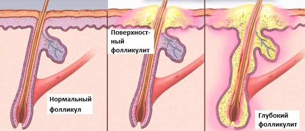 Что такое фолликулит и остиофолликулит