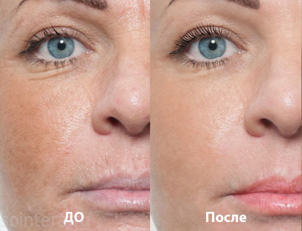 до и после мезотерапии лица